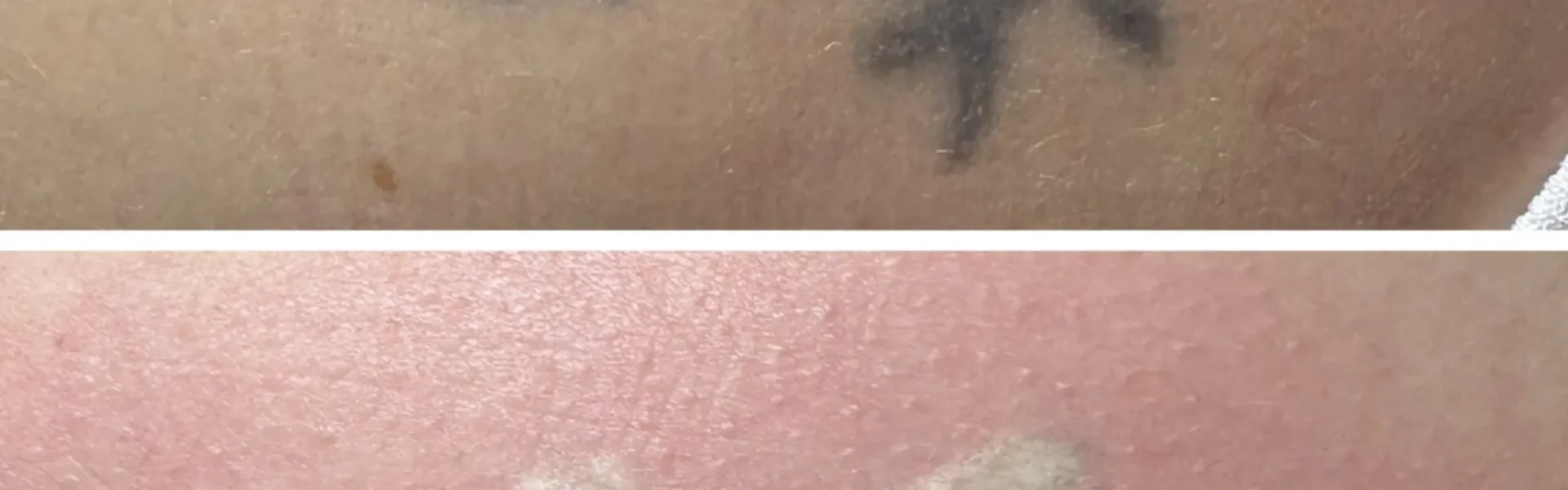 Does Tattoo Removal Leave Scars?