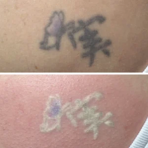 Does Tattoo Removal Leave Scars?