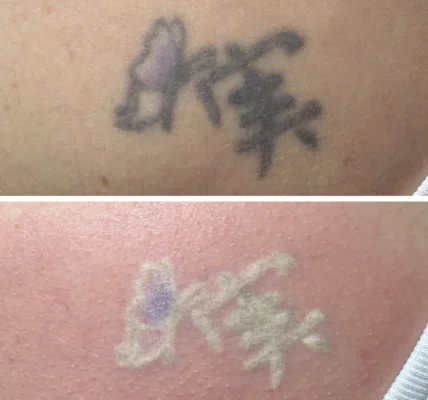 Does Tattoo Removal Leave Scars?