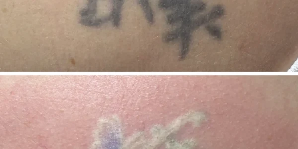 Does Tattoo Removal Leave Scars?