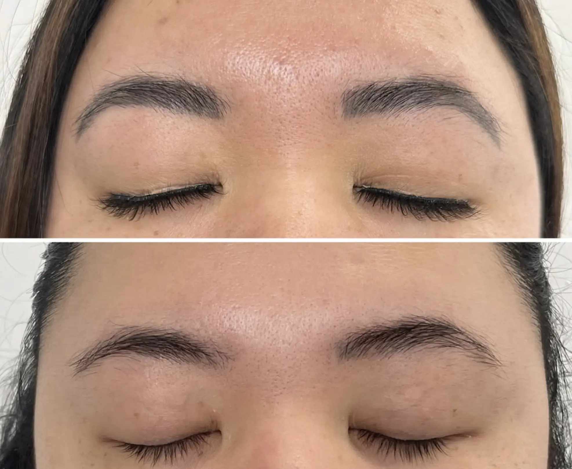 Eyebrow Tattoo Removal
