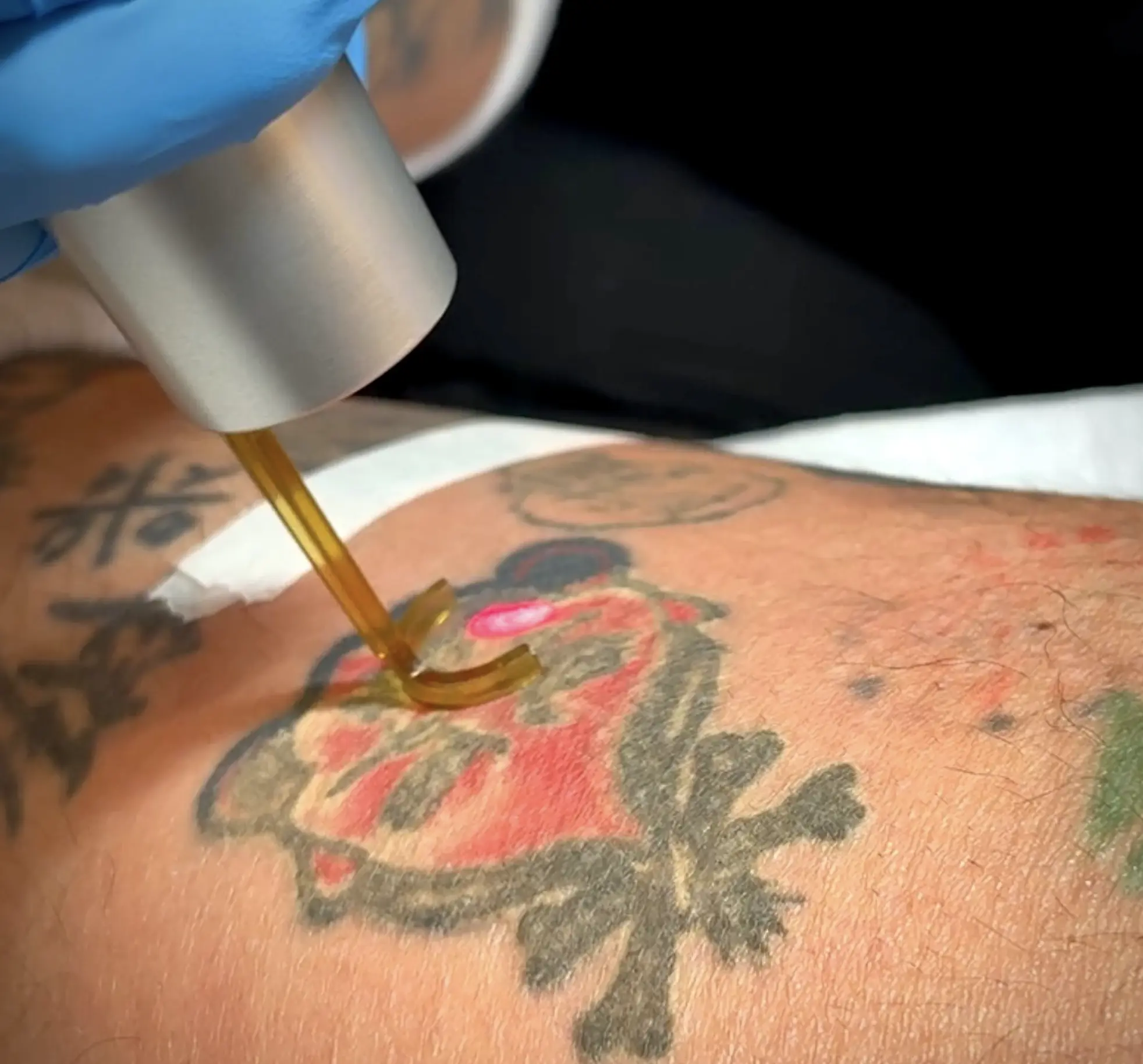 Laser Tattoo Removal Safety