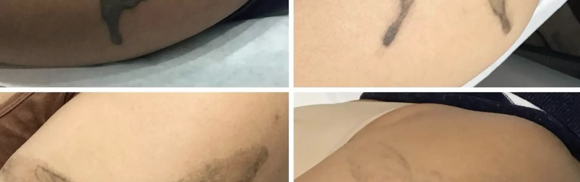 Risks of Tattoo Removal