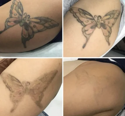 Risks of Tattoo Removal