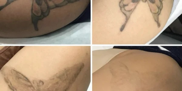 Risks of Tattoo Removal